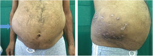 Abdominal distension and depigmented scarring along right T10–T12 dermatomes.