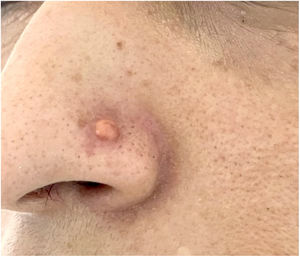 Small erythematous-brownish nodule adjacent to the nasal piercing.