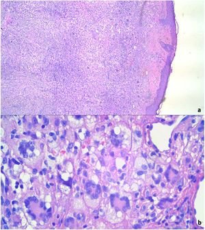 (a) Dense dermal histiocyte infiltrate (HE 100×). (b) Histiocytes and giant multinucleated Touton cells (HE 400×).