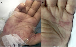 Hallazgos clínicos. (A, B). La exploración dermatológica reveló máculas anulares milimétricas de tonalidad eritematoviolácea en ambas palmas.