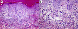 Estudio histológico. (A) La biopsia no demostró anomalías epidérmicas. Se observaba una infiltración neutrofílica dérmica superficial y focal que formaba microabscesos mal definidos, sin signos de vasculitis (HEx100). (B) A mayor aumento (HEx200), se confirmó la ausencia de vasculitis identificando también ligera cariorrexis y eosinófilos aislados.
