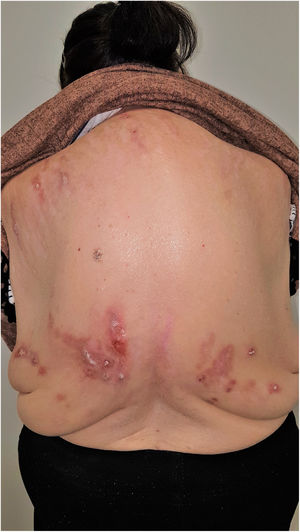 Signo de la mariposa.