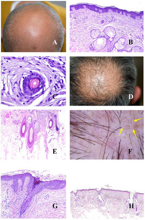 A: Alopecia androgénica. Numerosos tallos miniaturizados. B: Alopecia androgénica mostrando un folículo piloso miniaturizado en la parte alta de la dermis. En comparación, las gándulas sebáceas parecen tener un gran tamaño, a pesar de ser de morfología normal (hematoxilina-eosina ×40). C: Un detalle del folículo miniaturizado muestra el tallo piloso con un grosor menos que el de la vaina radicular interna (hematoxilina-eosina ×400). D: Alopecia androgénica. Anisotriquia, con gran variabilidad entre los diámetros de los tallos. E: Alopecia androgénica. Aunque la anisotriquia no puede ser fácilmente evaluada en la biopsia, la variabilidad entre el diámetro de los tallos a veces se ve incluso en biopsias pequeñas (hematoxilina-eosina ×40). F: Alopecia androgénica. Ocasionales pelos circulares. G: Alopecia androgénica. Los pelos circulares suelen estar por encima de la epidermis en la mayoría de los casos (hematoxilina-eosina ×40). H: Alopecia androgénica. Abundancia de folículos pilosos vacíos, sin tallo (hematoxilina-eosina ×20).