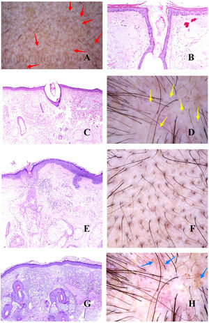A: Alopecia androgénica. Las flechas rojas marcan los puntos blancos de los acrosiringios. Los puntos blancos más anchos corresponden a folículos pilosos vacíos. B y C: Alopecia androgénica. En ocasiones, los infundíbulos foliculares sin tallo aparecen llenos de secreción sebácea y de queratina (B: hematoxilina-eosina ×100; C: hematoxilina-eosina ×20). D: Alopecia androgénica. Puntos amarillos correspondientes a los infundíbulos sin tallos llenos de secreción sebácea y queratina. E: Alopecia androgénica. Discreto infiltrado inflamatorio linfohistiocitario en torno al istmo del folículo (hematoxilina-eosina ×40). F: Alopecia androgénica. Halo marronáceo en torno a la salida de los tallos. G: Alopecia androgénica. Intensa elastosis solar dérmica rodeando los folículos pilosos miniaturizados (hematoxilina-eosina ×20). H: Alopecia androgénica. Panal pigmentado «en panal de abeja».