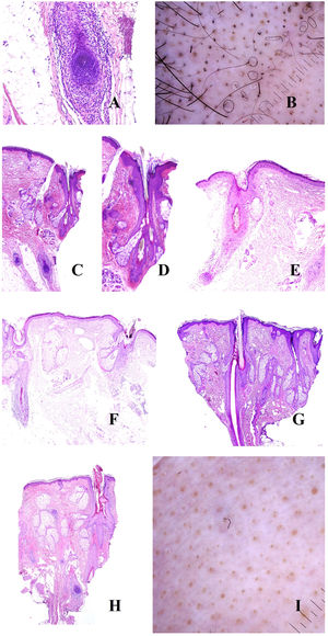 A: Alopecia areata. Infiltrado inflamatorio intenso peribulbar (hematoxilina-eosina ×100). B: Alopecia areata. Numerosos pelos en círculos. También se ven pelos fragmentados y puntos negros. C: Alopecia areata. Infitrado inflamatorio en torno a los bulbos. Dos tallos pilosos salen por el mismo infundíbulo (hematoxilina-eosina ×20). D: Alopecia areata. Detalle de la salida de dos tallos por el mismo infundíbulo (hematoxilina-eosina ×40). E: Alopecia areata. Evidencia del infiltrado inflamatorio peribulbar. El tallo piloso aparece fragmentado (hematoxilina-eosina ×20). F: Alopecia areata. Tallo piloso fragmentado en la salida del infundíbulo (hematoxilina-eosina ×20). G: Alopecia areata. Folículo piloso nuevo empujando al antiguo (hematoxilina-eosina ×20). H: Alopecia areata. Infundíbulo lleno con secreción sebácea y queratina (hematoxilina-eosina ×20). I: Alopecia areata. Numerosos puntos amarillos junto con algún ocasional pelo distrófico.