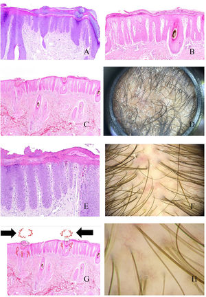 A: Alopecia en psoriasis. Engrosamiento epidérmico a expensas de las crestas interpapilares (hematoxilina-eosina ×20). B: Alopecia en psoriasis. Escama paraqueratótica (hematoxilina-eosina ×20). C: Alopecia en psoriasis. En esta biopsia, las escamas paraqueratóticas muestran localización infundibular (hematoxilina-eosina ×20). D: Alopecia en psoriasis. Moldes peripilares correspondientes a escamas de pataqueratosis infundibulares eliminadas con el crecimiento del tallo (cortesía de la Dra. Nerea Landa). E: Alopecia en psoriasis. Los vasos de la dermis papilar aparecen tortuosos y dilatados. Mientras que los de la derecha están en zonas de gran adelgazamiento epidérmico suprapapilar y se verán como asas rojas retorcidos, los de la izquierda están bajo una epidermis de un grosor un poco más conservado, y se verán en la tricoscopia como asas rojas simples (hematoxilina-eosina ×40). F: Puntos rojos (cortesía del Dr. David Saceda). G: Cuando las asas capilares papilares tortuosas aparecen rodeando una escama paraqueratótica, se produce una imagen muy característica en la tricoscopia (hematoxilina-eosina ×20). H: Vasos tortuosos (cortesía del Dr. David Saceda).