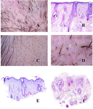 A: Tricotilomanía. Tallos rotos a distintos niveles. B: Tricotilomanía. Depósito de pigmento melánico en el tallo folicular de la izquierda. Los dos infundíbulos de la derecha aparecen dilatados y con gran contenido queratínico. C: Tricotilomanía. Presencia de «polvo piloso» (hair dust) en muchos de los infundíbulos. D: Tricotilomanía. La tricoscopia muestra algunos pelos «en V». E y F: Efluvio telógeno. Folículos pilosos en telógeno junto a folículos pilosos vacíos, evidenciados tanto en cortes verticales como horizontales (E: hematoxilina-eosina ×20; F: hematoxilina-eosina ×20).