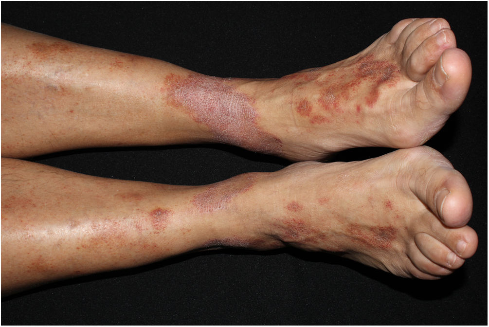[Translated article] Pruritic Red-Brown Purpuric Plaques With ...