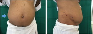 Distensión abdominal y placas costrosas afectando dermatomas T11-T12 del lado derecho.