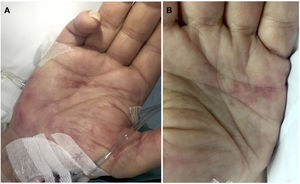 Clinical findings. (A and B) Dermatologic examination revealed millimetric annular macules with an erythematous-violaceous coloration on both palms.