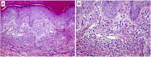 Histologic findings of a biopsied lesion showed dermal but no epidermal abnormalities. (A) Superficial dermal neutrophilic focal infiltration forming poorly defined microabscesses with no signs of vasculitis (hematoxylin–eosin, original magnification ×100). (B) Further enlargement (original magnification ×200) confirmed the absence of vasculitis and also identified mild karyorrhexis and isolated eosinophils.