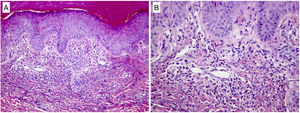 Histologic findings of a biopsied lesion showed dermal but no epidermal abnormalities. (A) Superficial dermal neutrophilic focal infiltration forming poorly defined microabscesses with no signs of vasculitis (hematoxylin–eosin, original magnification ×100). (B) Further enlargement (original magnification ×200) confirmed the absence of vasculitis and also identified mild karyorrhexis and isolated eosinophils.
