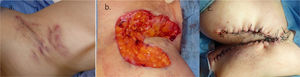 Resección local amplia del área afectada. a) Axila con lesiones de hidradenitis supurativa (Hurley III). b) Extirpación completa de una zona afectada, alcanzando el planode tejido graso subcutáneo clínicamente libre de enfermedad. c) Reconstrucción con colgajo de avance para reparar el defecto quirúrgico.