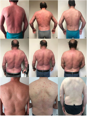 Caso 1: paciente con psoriasis eritrodérmica al inicio (a) y transcurridas 6 (b) y 14 (c) semanas de la primera inyección de brodalumab; Caso 2: paciente con psoriasis eritrodérmica al inicio (d) y transcurridas 4 (e) y 8 (f) semanas de la primera inyección de brodalumab; Caso 3: paciente con psoriasis eritrodérmica al inicio (g) y transcurridas 4 (h) y 8 (i) semanas de la primera inyección de brodalumab.