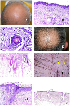 A, Androgenetic alopecia. Numerous miniaturized hair shafts. B, Androgenetic alopecia showing a miniaturized hair follicle in the upper part of the dermis. Compare with the sebaceous glands, which appear large in size, despite their normal morphology (hematoxylin-eosin [H-E], ×40). C, Detail of a miniaturized hair follicle showing a shaft that is thinner than the internal root sheath (H-E, ×400). D, Androgenetic alopecia. Anisotrichosis, with marked variation between shaft diameters. E, Androgenetic alopecia. While anisotrichosis is not easily evaluated in biopsy specimens, variations in shaft diameter can even be seen in small specimens (H-E, ×40). F, Androgenetic alopecia. Occasional circle hairs. G, Androgenetic alopecia. Circle hairs are above the epidermis in most cases (H-E, ×40). H, Androgenetic alopecia. Abundant empty hair follicles, with no shaft (H-E, ×20).