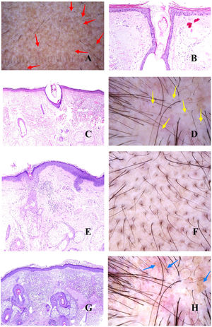 A, Androgenetic alopecia. The red arrows indicate the white dots of the acrosyringia. The widest white dots correspond to empty hair follicles. B and C, Androgenetic alopecia. Follicular infundibula without a shaft may be filled with sebaceous material and keratin (B, hematoxylin-eosin [H-E], ×100; C, H-E, ×20). D, Androgenetic alopecia. Yellow dots corresponding to infundibula without hair shafts filled with sebum and keratin. E, Androgenetic alopecia. Discrete lymphohistiocytic inflammatory infiltrate surrounding the isthmus of the hair follicle (H-E, ×40). F, Androgenetic alopecia. Brownish halo surrounding the follicular opening. G, Androgenetic alopecia. Intense solar elastosis surrounding miniaturized hair follicles (H-E, ×20). H, Androgenetic alopecia. Pigmented area with honeycomb pattern.