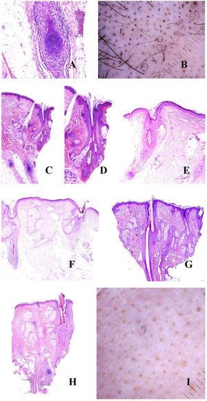 A, Alopecia areata. Intense peribulbar inflammatory infiltrate (hematoxylin-eosin [H-E], ×100). B, Alopecia areata. Numerous circle hairs. Note also broken hairs and black dots. C, Alopecia areata. Peribulbar inflammatory infiltrate. Two hair shafts emerging from the same infundibulum (H-E, ×20). D, Alopecia areata. Detail of the point where 2 shafts emerge from the same infundibulum (H-E, ×40). E, Alopecia areata. Evidence of a peribulbar inflammatory infiltrate. The hair shaft is seen to be broken (H-E, ×20). F, Alopecia areata. Broken hair shaft at the point where it emerges from the infundibulum (H-E, ×20). G, Alopecia areata. New hair follicle pushing the old one (H-E, ×20). H, Alopecia areata. Infundibulum filled with sebaceous secretion and keratin (H-E, ×20). I, Alopecia areata. Numerous yellow dots, together with an occasional dystrophic hair.