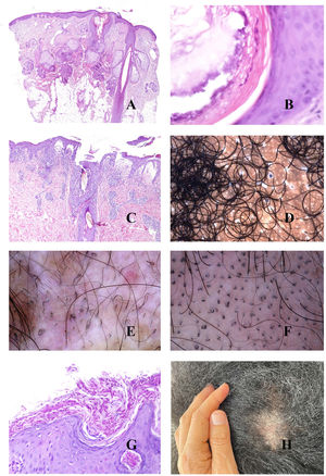 A and B, Tinea capitis. Fungal invasion of infundibular keratin (A, hematoxylin-eosin [H-E], ×20; B, H-E, ×400). C, Breakage of the shaft in a case of tinea capitis (H-E, ×20). D, Tinea capitis. Black dots. E, Tinea capitis. Numerous corkscrew hairs. F, Tinea capitis. Numerous comma hairs. G, Tinea capitis. Keratotic scale with very abundant fungal microorganisms (H-E, ×200). H, Tinea capitis. Peri- and interfollicular scales (image courtesy of Dr. Nerea Landa).
