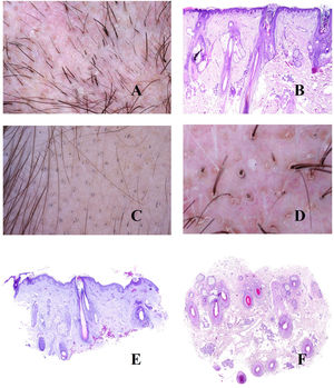 A, Trichotillomania. Shafts broken at different levels. B, Trichotillomania. Melanin pigment deposit on the follicular shaft on the left. The 2 infundibula on the right appear dilated and with marked keratin content. C, Trichotillomania. Presence of hair powder in many infundibula. D, Trichotillomania. Trichoscopy shows some V hairs. E and F, Telogen effluvium. Hair follicles in telogen, together with empty hair follicles, visible both in vertical and in horizontal slices (E, hematoxylin-eosin [H-E], ×20; F, H-E, ×20).