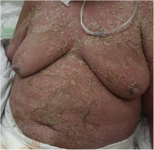 Dry erythroderma.