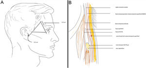 A) Zona 1: rama temporal del nervio facial (VII). B) Planos cutáneos de la zona.