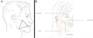 A) Zona 3: conducto parotídeo y ramas cigomáticas y bucales del nervio facial (VII). B) Zona 3: localización del conducto parotídeo.