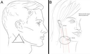 A) Zona 4: nervio auricular mayor. B) Zona 4: nervio accesorio (XI).