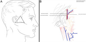 A) Zona 5: vasos temporales superficiales y nervio auriculotemporal. B) Localización de vasos temporales y su relación con el nervio auriculotemporal.