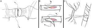 A) Sutura bidireccional de estructura vascular con clampaje previo mediante pinzas de DeBakey. B) Arterioplastia. C) Injerto espiral de vena.