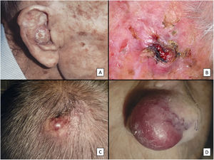 Características clínicas del SPD. A) Tumoración nodular de gran tamaño que ocupa la totalidad de la concha auricular infiltrada a planos profundos. B) Tumor de aspecto carnoso y friable, ulcerado, localizado en el cuero cabelludo de un varón con evidente daño solar. C) Tumor nodular con vascularización prominente en el cuero cabelludo de un varón anciano. D) Tumor eritemato-violáceo de gran tamaño, con vascularización prominente en el ala nasal de una mujer anciana, con infiltración transmural del cartílago alar.