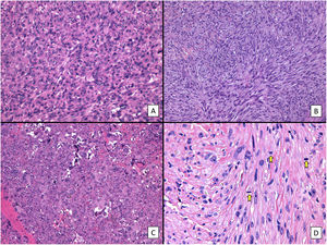 Características histológicas del SPD (hematoxilina-eosina). A) Proliferación densamente celular constituido por sábanas de células epitelioides, con nucléolo prominente, que presentan además marcado pleomorfismo y atipia celular (×200). B) Proliferación densamente celular constituido por fascículos de células de aspecto fusiforme, de nuevo con marcado pleomorfismo y atipia celular (×200). C) Células de aspecto monstruoso con núcleos grandes y atípicos, con nucléolo prominente, y citoplasmas amplios y de aspecto xantomizado. Se observan numerosas células multinucleadas, así como núcleos marcadamente picnóticos (×200). D) Proliferación celular con marcado pleomorfismo y atipia, similar a las imágenes previas, en la que son evidentes múltiples figuras de mitosis (señaladas por flechas amarillas; ×400).