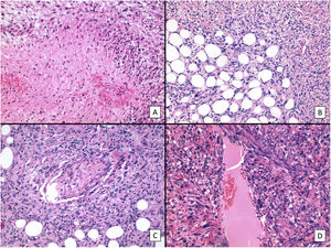 Criterios histológicos de agresividad que definen al SPD (hematoxilina-eosina). A) Necrosis (×200). B) Infiltración franca del tejido celular subcutáneo (×200). C) Infiltración perineural. D) Infiltración vascular.