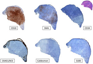 Panel de inmunohistoquímica típico del SPD. Para el diagnóstico del SPD, siempre es necesario descartar otros tumores indiferenciados: el carcinoma epidermoide cutáneo con tinción de citoqueratinas negativa (CKAE1-AE3); el melanoma maligno con S100 y/o otros marcadores melanocíticos negativos; y el leiomiosarcoma (caldesmon negativo). Aunque no es específico, el marcador CD10 suele ser positivo. También puede haber positividad focal para la actina (SMA), y para la vimentina (no mostrada en la imagen).