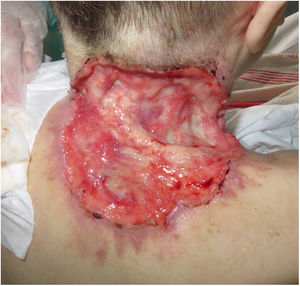Advanced basal cell carcinoma on the neck.
