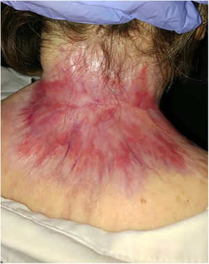 Complete response after 6 months of treatment with HhI.