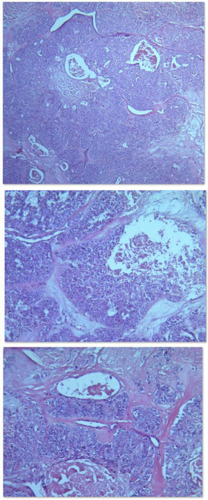 A, Solid area of the tumor with foci of necrosis and bleeding (hematoxylin–eosin [H–E], 50×). B, Epithelial cell nests with central necrosis and atypia surrounded by stroma with a mucinous appearance (H–E, 100×). C, Epithelial cell cords and nests surrounded by fibrous stroma, with foci of tumor necrosis (H–E, 100×).