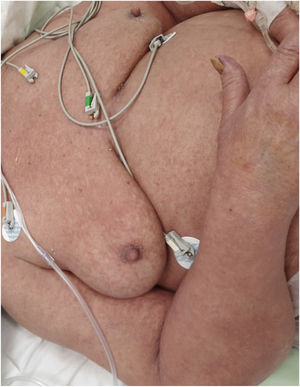 Mejoría de la eritrodermia tras la corrección de la calcemia.