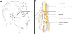 A, Zone 1: Temporal branch of the facial nerve (VII). B, Tissue planes in the zone. SMAS indicates superficial musculoaponeurotic system.