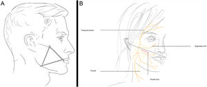 A, Zone 3: Parotid duct and zygomatic and buccal branches of the facial nerve (VII). B, Zone 3: Location of the parotid duct.