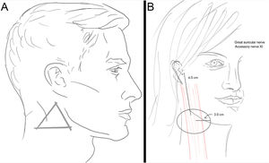 A, Zone 4: Great auricular nerve. B, Zone 4: Accessory nerve (XI).