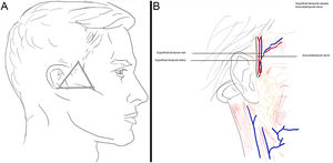 A, Zone 5: Superficial temporal vessels and auriculotemporal nerve. B, Location of the temporal vessels and their relationship with the auriculotemporal nerve.