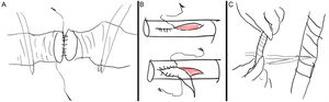 A, Two-directional suture of a vascular structure after clamping with DeBakey forceps. B, Arterioplasty. C, Spiral vein graft.