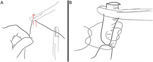 A, Ligation of a vascular structure. B, Transfixion suture.