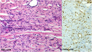 a) Tinción hematoxilina-eosina ×100. b) FXIIIa, ×100.