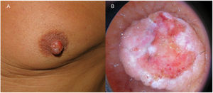 A) Aumento de volumen del pezón izquierdo. B) En la dermatoscopia se observaban áreas rojo-lechosas, ulceración central y vasos polimórficos.