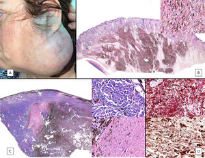 A, Large mass on the skin of the mastoid area on a blue plaque situated on the skin of the left pinna, preauricular region, and side of the neck. B, Plaque-type blue nevus. Panoramic view with inset showing detail: bundles of spindle cells, abundant melanophages, and sclerotic collagen occupying the subcutaneous fat and, to a lesser extent, the dermis, albeit without involvement of the dermal–epidermal junction. C, Central area of the tumor: note the predominance of dense sheets of epithelioid and pleomorphic cells replacing the pre-existing structures. The lower half of the inset shows areas of mass coagulative necrosis. The upper half of the inset shows densely melanocytic areas with no melanin content. D, Upper panel. Nuclear expression of BAP1 (in red) preserved in the plaque-type blue nevus portion. Lower panel. Loss of BAP1 expression in the nuclei of the melanoma portion.