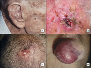 Clinical characteristics of pleomorphic dermal sarcoma. A, Large nodular tumor occupying the entire concha and invading the deeper layers. B, Ulcerated tumor with a fleshy, friable appearance on the scalp of a man with evident sun damage. C, Nodular tumor with prominent vascular features on the scalp of an older man. D, Large erythematous–violaceous tumor with prominent vascular features on the nasal ala of an older woman, with transmural invasion of the alar cartilage.