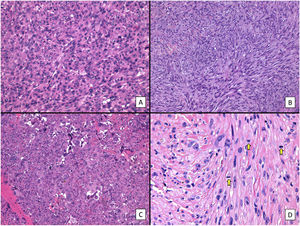 Histologic features of pleomorphic dermal sarcoma (hematoxylin–eosin). A, Dense cell proliferation formed by sheets of epithelioid cells with prominent nucleoli and pronounced pleomorphism and cellular atypia (original magnification ×200). B, Dense cell proliferation formed by bundles of spindle-shaped cells with pronounced pleomorphism and cellular atypia (original magnification ×200). C, Monster cells with large, atypical nuclei, prominent nucleoli, and large cytoplasms with a xanthomatous appearance. Note the numerous multinucleated cells and markedly pyknotic nuclei (original magnification ×200). D, Cell proliferation with marked pleomorphism and atypia, similar to in the previous images, but with multiple mitotic figures (yellow arrows) (original magnification ×400).