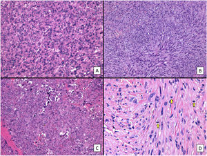Histologic features of pleomorphic dermal sarcoma (hematoxylin–eosin). A, Dense cell proliferation formed by sheets of epithelioid cells with prominent nucleoli and pronounced pleomorphism and cellular atypia (original magnification ×200). B, Dense cell proliferation formed by bundles of spindle-shaped cells with pronounced pleomorphism and cellular atypia (original magnification ×200). C, Monster cells with large, atypical nuclei, prominent nucleoli, and large cytoplasms with a xanthomatous appearance. Note the numerous multinucleated cells and markedly pyknotic nuclei (original magnification ×200). D, Cell proliferation with marked pleomorphism and atypia, similar to in the previous images, but with multiple mitotic figures (yellow arrows) (original magnification ×400).