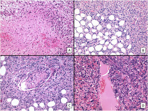 Histologic features indicative of aggressiveness in PDS (hematoxylin–eosin). A, Necrosis (original magnification ×200). B, Evident subcutaneous invasion (original magnification ×200). C, Perineural invasion. D, Vascular invasion.